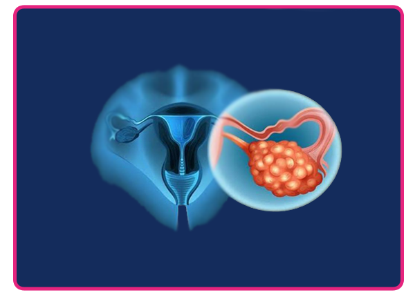 Ovarian Cancer Treatment