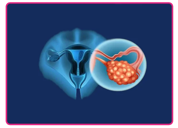 Ovarian Cancer Treatment