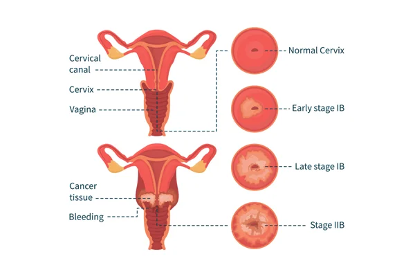 Cervical Cancer Treatment
