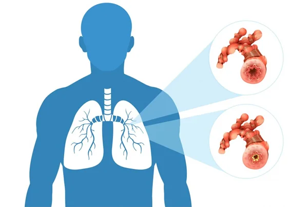 Lung Cancer Treatment