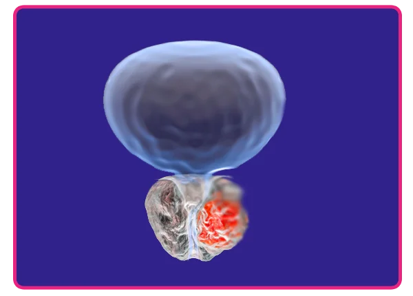 Prostate Cancer Treatment