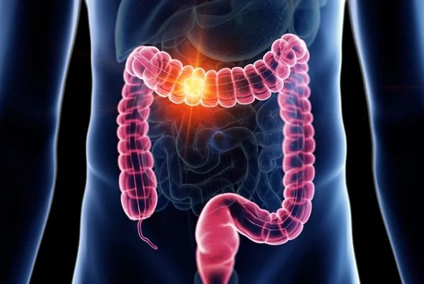 Colon Cancer Treatment