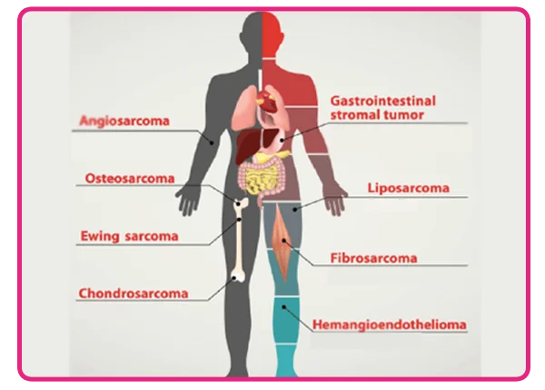 Sarcomas Treatment