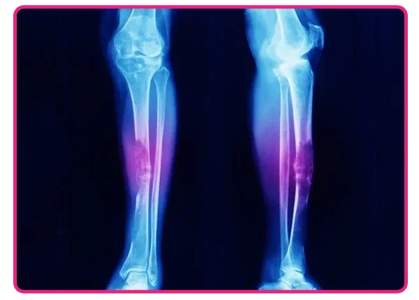 Bone Cancer Treatment